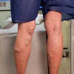 back veiw of leg before treatment