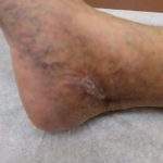 Varicose Vein Treatment in Chicago: Leg Discoloration